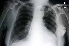 xray_pacemaker